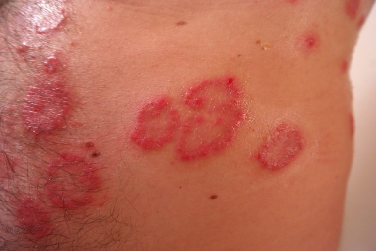 dermatitis